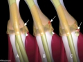 Entorse du pouce : diagnostic et opération