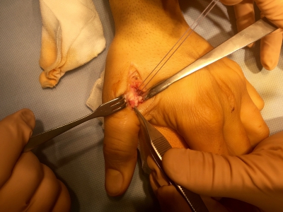 Reinsertion trans-osseuse du LLI sur ancre de suture