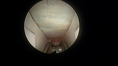 Endoscope introduit sous ligament transverse
