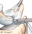 reparation arthroscopique du ligament scapho-lunaire