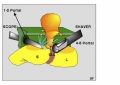 kyste synovial du poignet