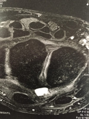 Kyste posterieur du ligament scapho-lunaire vu en IRM