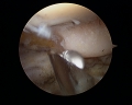 Scaphoidectomie partielle sous arthroscopie