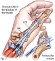 Tendinite du poignet (de quervain) - Dr Fontes Chirurgien de la