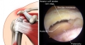 Rupture de la coiffe - vue arthroscopique